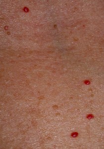 Cherry Angiomas Associated With Bromine Toxicity And Iodine