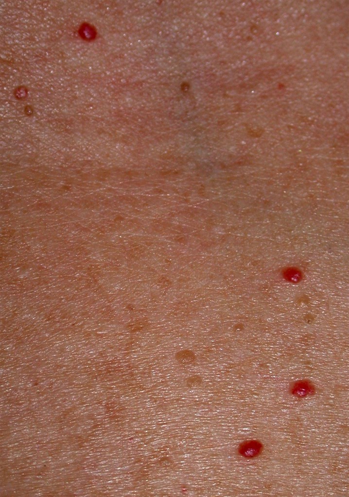 red pinpoint spots under skin